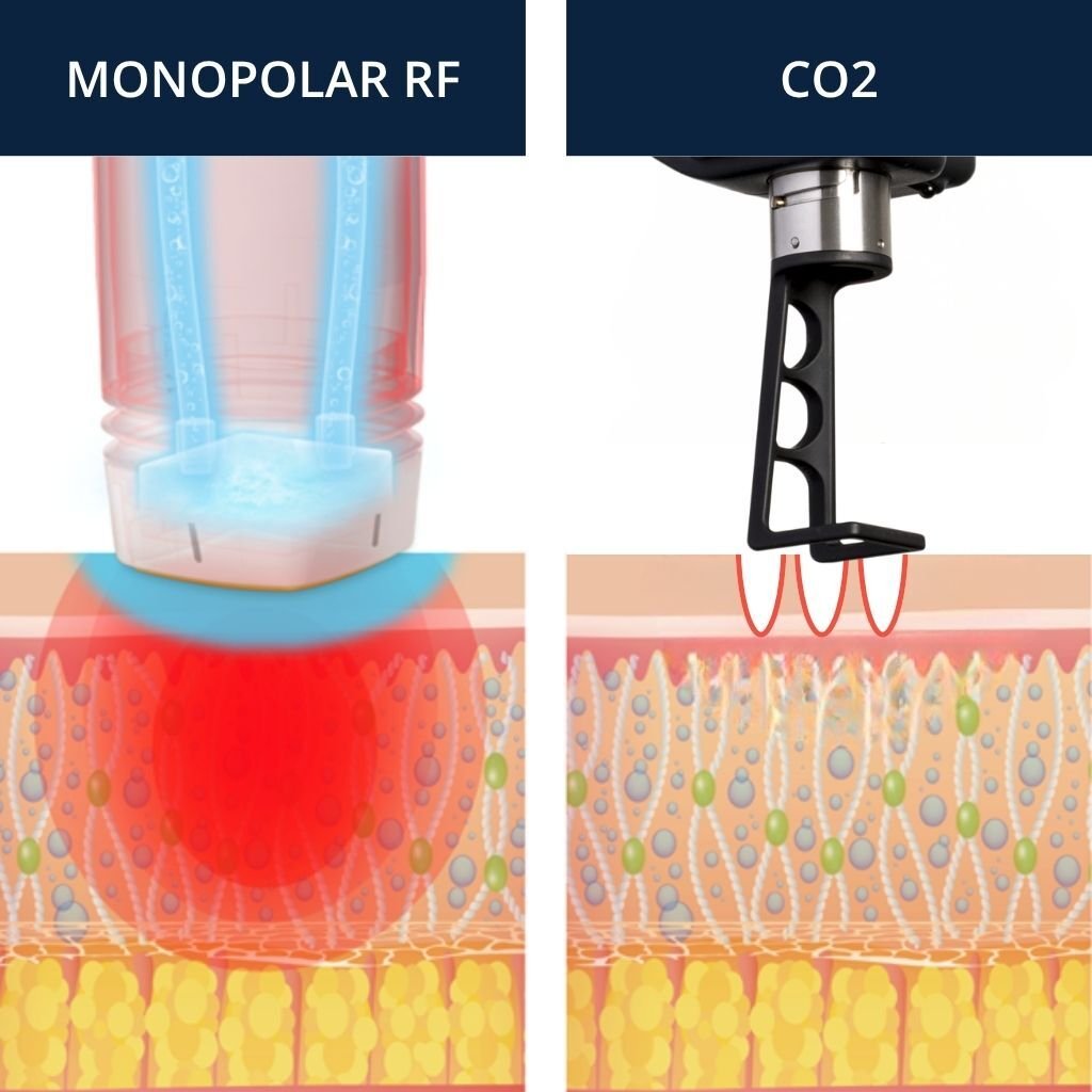 RadiantLift technology showing Monopolar RF and CO2 technology