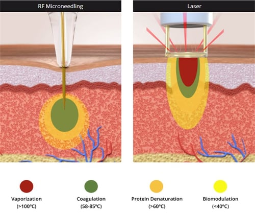 Illustration of RF Microneedling vs. Laser treatment with vaporization, coagulation, protein denaturation and biomodulation levels Illustration of RF Microneedling vs. Laser treatment with vaporization, coagulation, protein denaturation and biomodulation levels